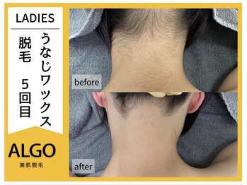 アルゴ 福井店(ALGO)/光×ワックスで即日効果を実感！
