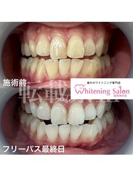 ホワイトニングサロン 福岡博多店/ホワイトニング