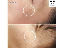 サロン ウーカ(salon WOOCA)/シミケアペン