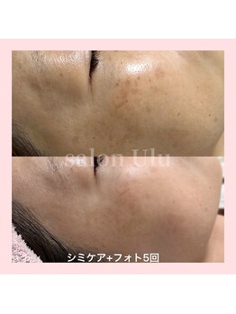 ウル(Ulu)/シミケアと同時施術可能！