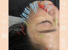 健志接骨院/マロン鍼