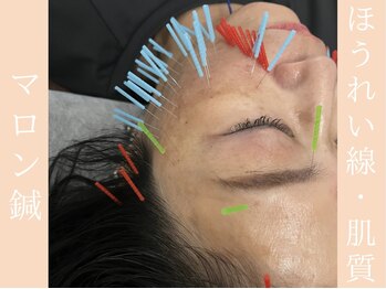 健志接骨院/マロン鍼