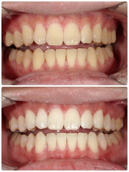 ホワイトニングサロンボーテ北浜の写真/【挙式直前でもOK】最短30分で完了するスピードホワイトニング！ドレスに映える真っ白な歯で最高の1日を◎