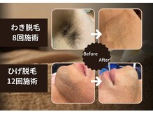 モア(MORE)の雰囲気（before after）