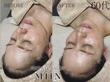 ミイン(miin)/韓国肌管理LHALALA ララピール　