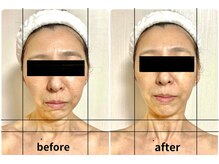 アグレーブル(Agreable)/【お顔の経過写真】