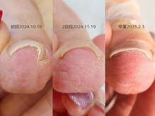 ネイル サロン アールズ ネイル(R's nail)の雰囲気（【巻き爪ケア】あなたの爪も変われます！相談だけでもOK！！）