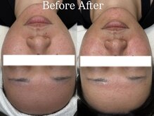 ハウピア(Haupia)/プラズマビフォーアフター