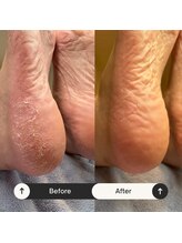 マオヌー(MAONU)/韓国式足裏角質ケア　症例写真