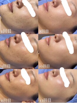 ベル 赤羽(Belle)/韓国肌管理｜エステダーマ