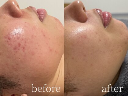 ハーブピーリング専門店lumeの写真