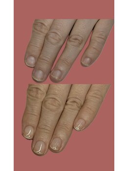 ネイルトラブル Before After