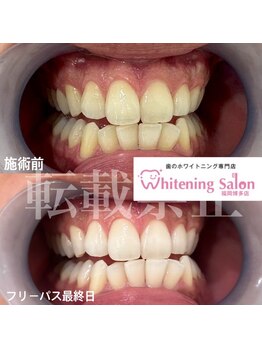 ホワイトニングサロン 福岡博多店/ホワイトニング