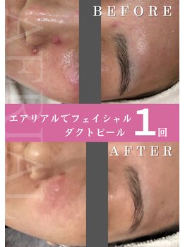 エアリアル 中津店/韓国式肌育メニューダクトピール