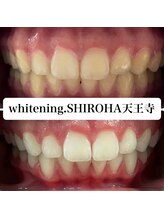 シロハ(SHIROHA)/セルフホワイトニング/天王寺