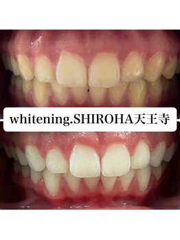 シロハ(SHIROHA)/セルフホワイトニング/天王寺