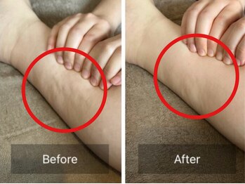 アピアランスビューティー 表参道店/足の脂肪ビフォー/アフター