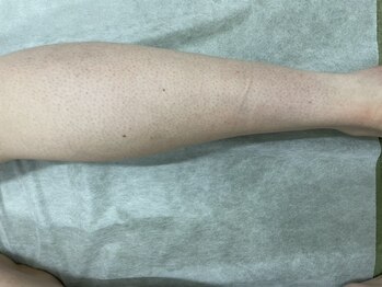 ナノハナ/鹿沼市の全身脱毛美容室ナノハナ