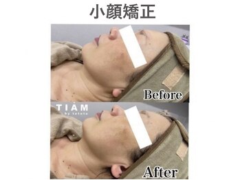 ティアム バイ テトテ 神戸三宮(TIAM by tetote)/小顔矯正