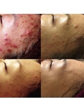 イリゼ(iriser)/プラズマフェイシャル