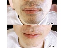 ビビ イーストフィールド 天白 名古屋(vivi)/ひげ脱毛6回経過♪