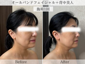 フラリ 西葛西(Hulali)/【40代】顔+背中で上半身痩せ