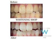 ホワイトニングショップ 甲賀店/Before&After『ホワイトニング』