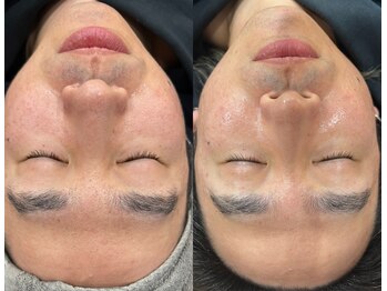 ビオラス(VIOLUS)/30代男性/フェイスワックス