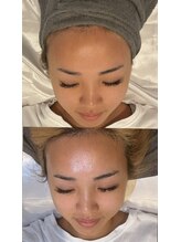 モアサロン(MOA salon)/初回ララピールビフォーアフター