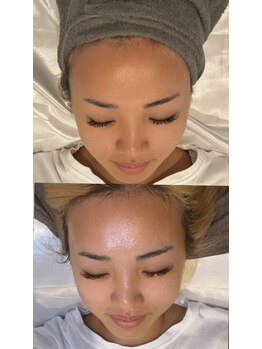 モアサロン(MOA salon)/初回ララピールビフォーアフター