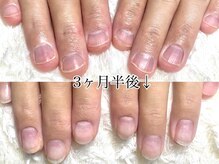 グラシナ なんば店/深爪/自爪育成/フィルイン
