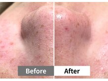 アーキ(ARCHI)/【稲沢/毛穴洗浄】毛穴洗浄