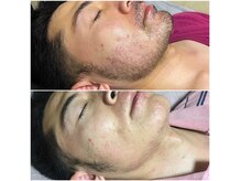 トータルメンズエステ キング(KING)の雰囲気（【脱毛機5種類】他店や医療でも満足な仕上がりじゃない方に是非!）