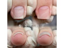マイ 浦和店(MY)/巻き爪矯正