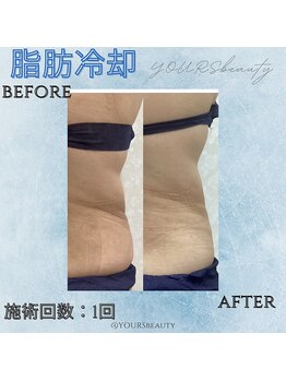 ユアーズ ビューティー(YOURS beauty)/脂肪冷却