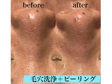 レアマカナ(LeaMakana)/毛穴洗浄＋ピーリング