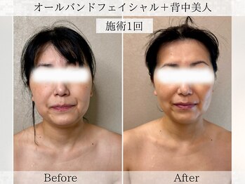 フラリ 西葛西(Hulali)/【40代】顔+背中で上半身痩せ