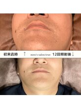 トゥルー(true)/ヒゲ脱毛　経過写真