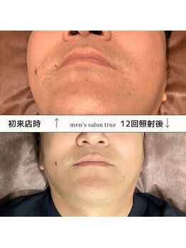 トゥルー(true)/ヒゲ脱毛　経過写真