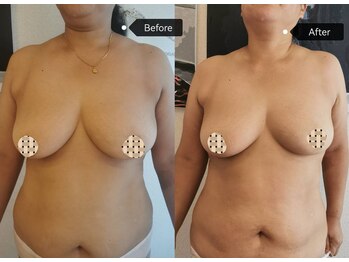 シークレット(Secret)/痩身