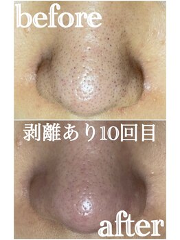 エミルカ 千葉店(EMILUCA)/ハーブピーリング/毛穴詰まり