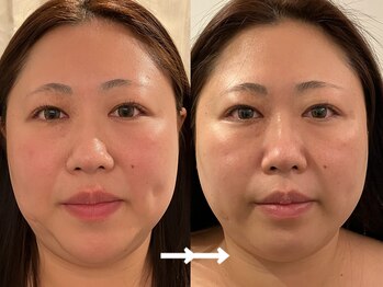 ヴィセラ(Vicella)/美肌脱毛だけじゃない!