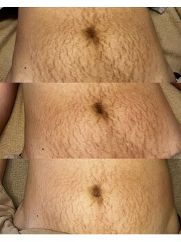 美温(mion)/妊娠線/ストレッチマークケア