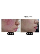 アオヤマ サロン ワイゼット(AOYAMA SALON YZ)/ニキビ肌ケア