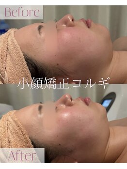 モア 星ヶ丘店(MORE)/小顔コルギ
