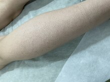 ナノハナ/鹿沼市の全身脱毛美容室ナノハナ