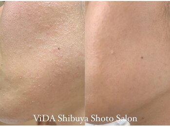 ヴィーダ 渋谷松濤(ViDA)/繰り返す肌荒れ改善
