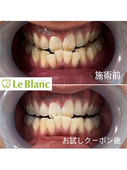 ルブラン 奈良店(Le Blanc)/黄ばみが気になる方!
