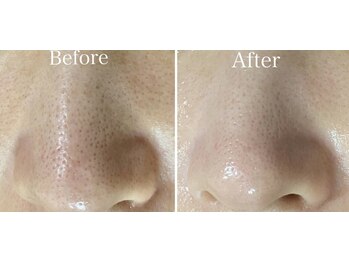 オレンジ(Orange)/【顔全体】毛穴・角質ケア120分