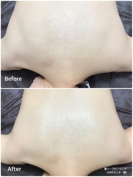 ラウレア 松山店(LAULEA)/背中ハーブピーリング　B/A